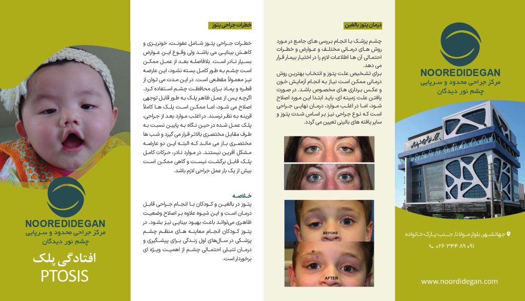 افتادگی پلک

Ptosis