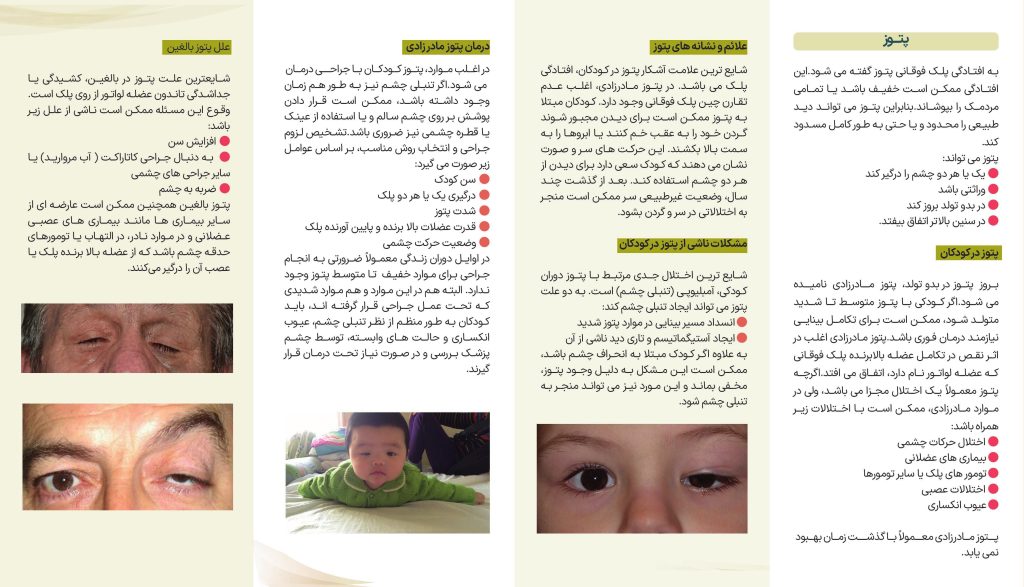 افتادگی پلک

Ptosis